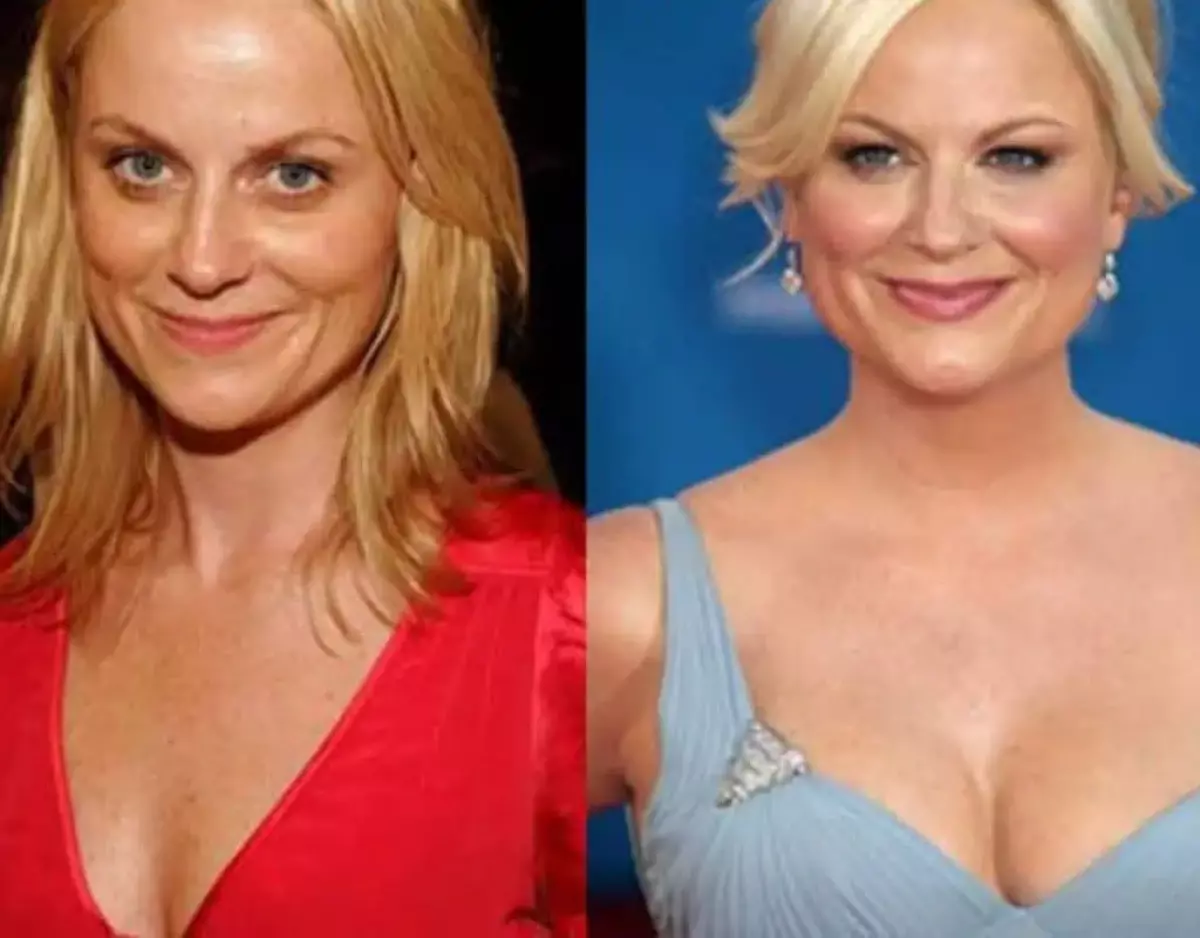 Amy Poehler before and after plastic surgery photos.